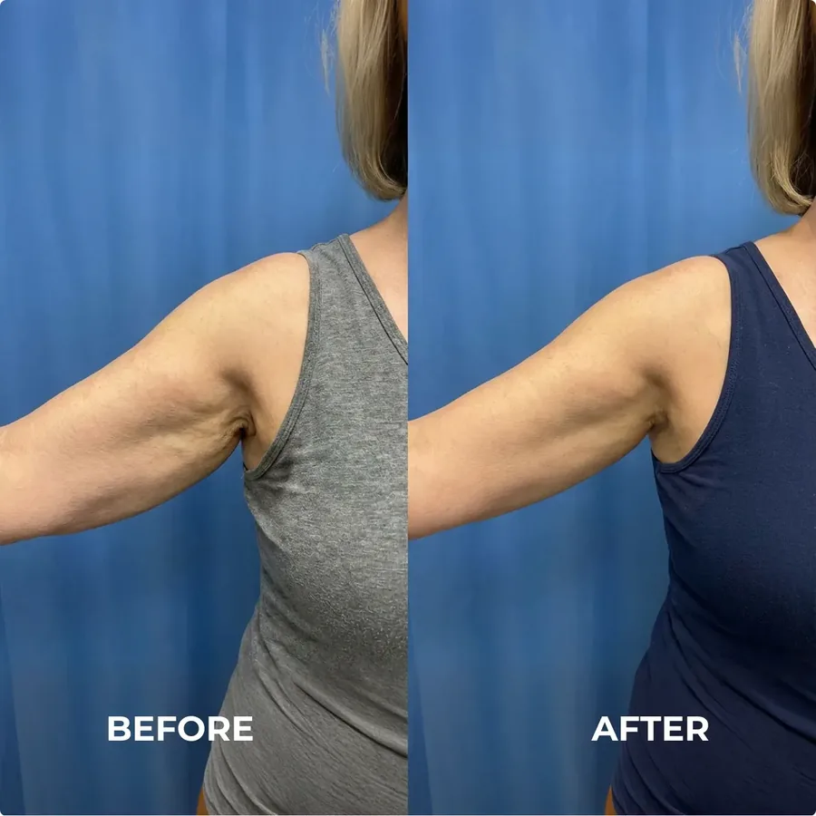 Before and after: back of the arm with MyoGlow