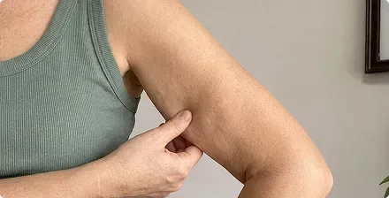 Pinching soft, crepey skin on the back of the arm